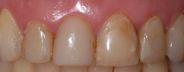 Dopo lo sbiancamento dei denti
