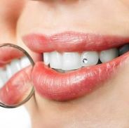 cura dei denti a Torino
