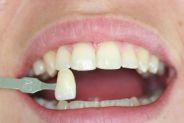 faccette dentali