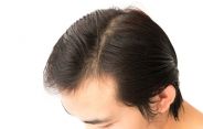 trapianto capelli trapianto capelli