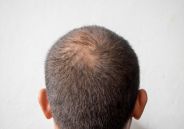  Finasteride 